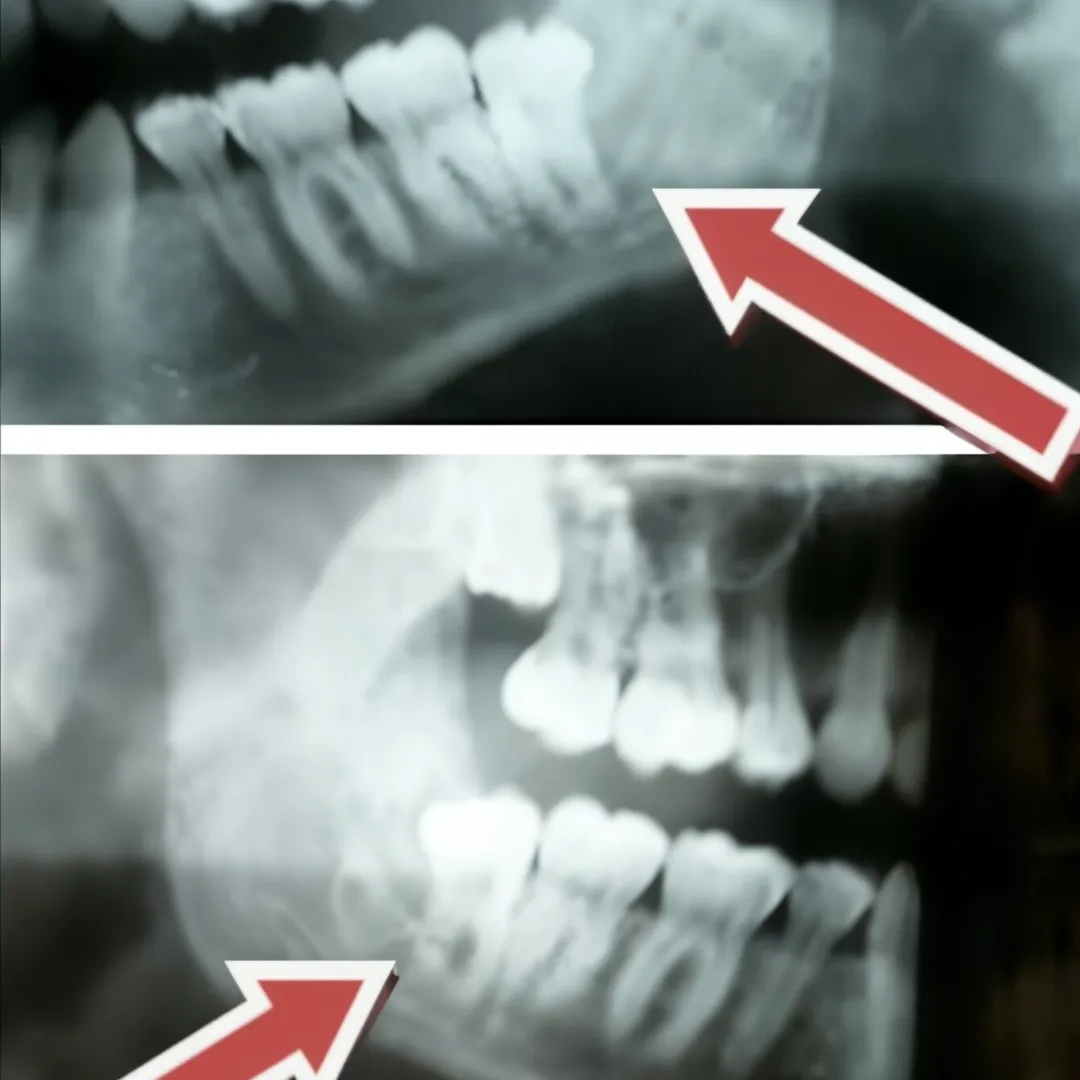 Nerve injury 