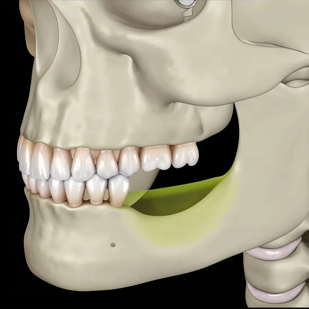 Residual ridge resorption 
