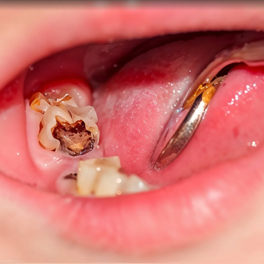 Tooth decay and gum issues 