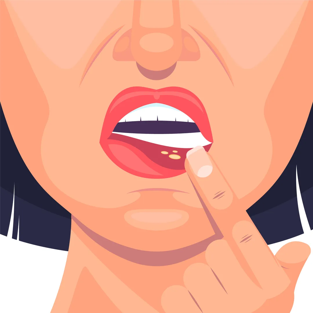 Stomatitis 