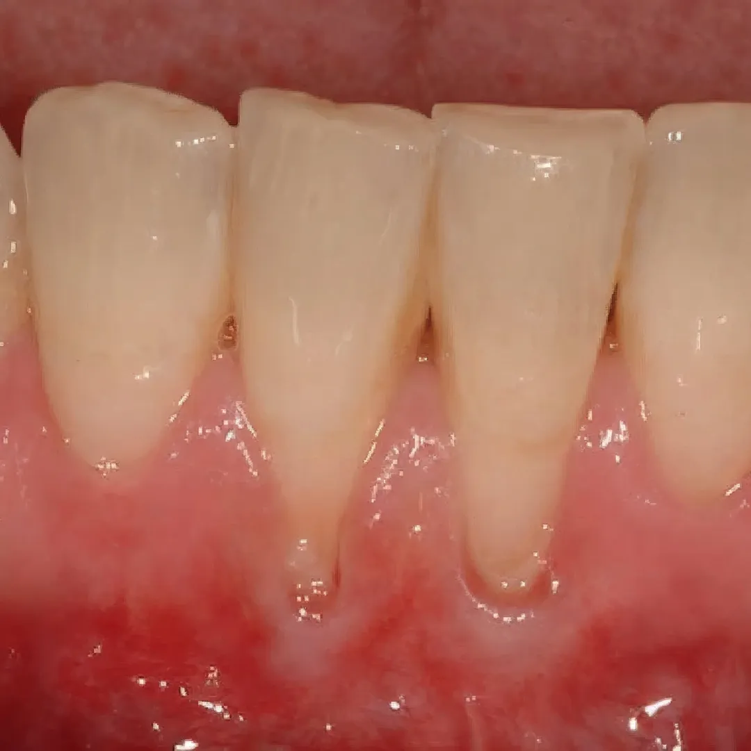 Gum recession 